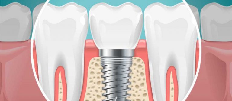 A diagram of implants.