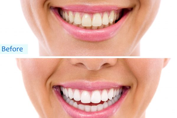 A before and after image of teeth whitening.