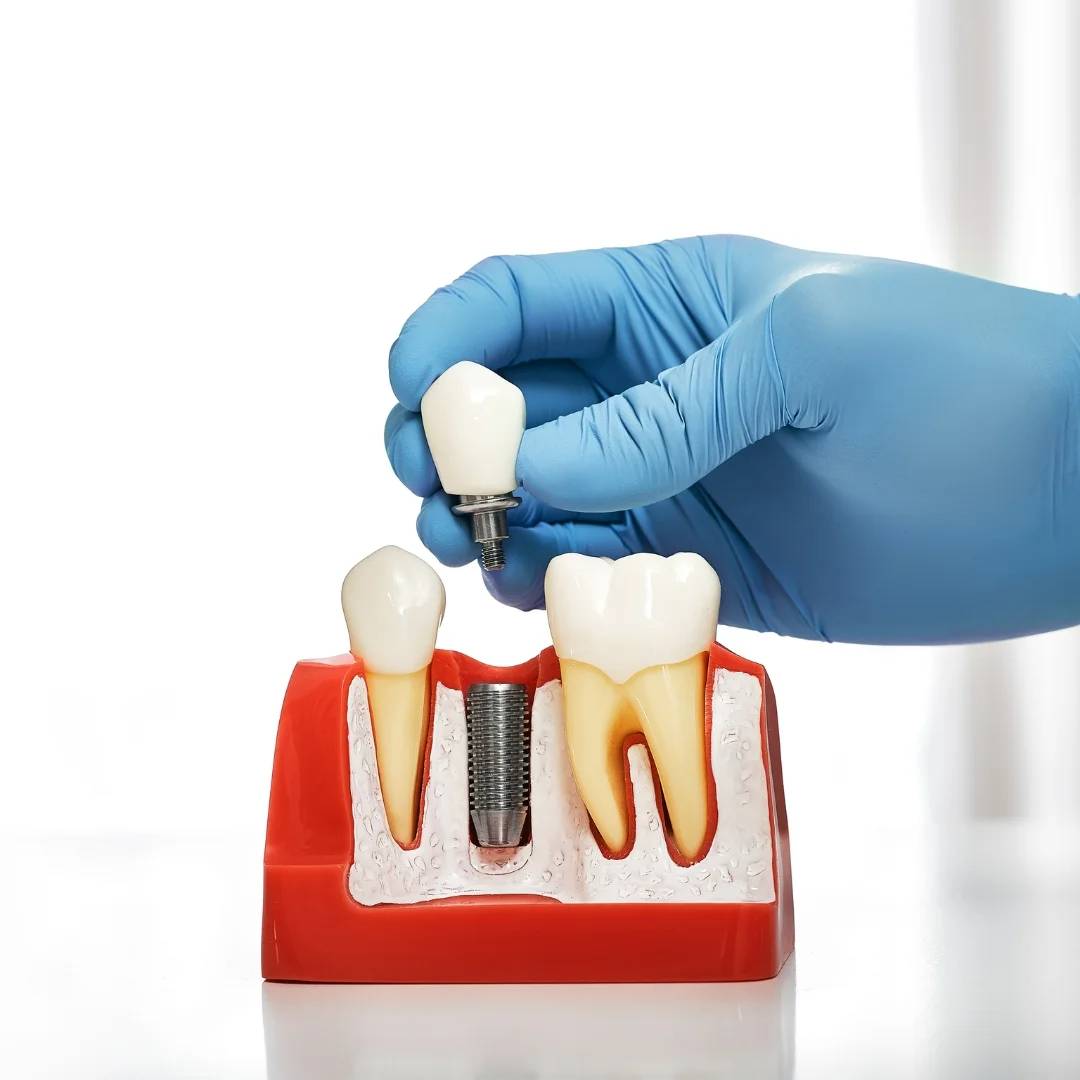 Dental Implants in Shelburne, ON