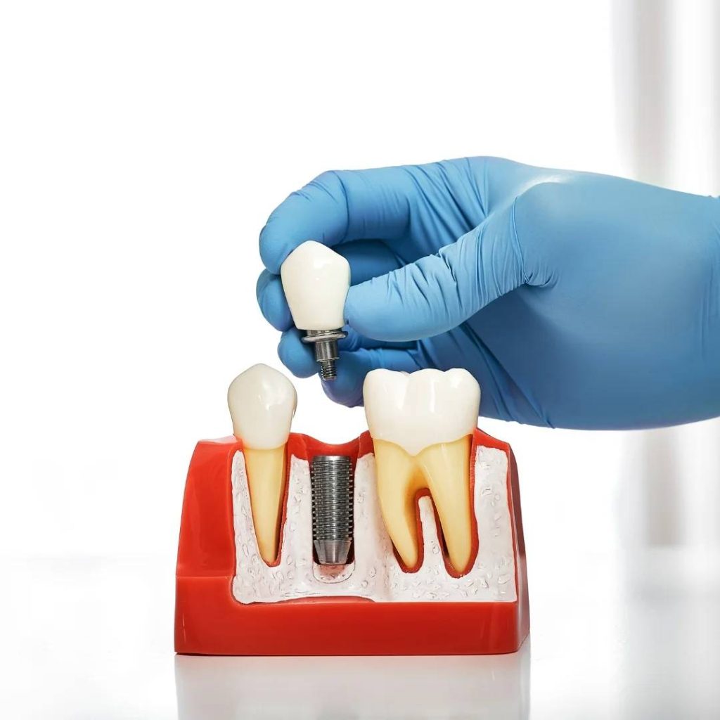dental implants in Shelburne