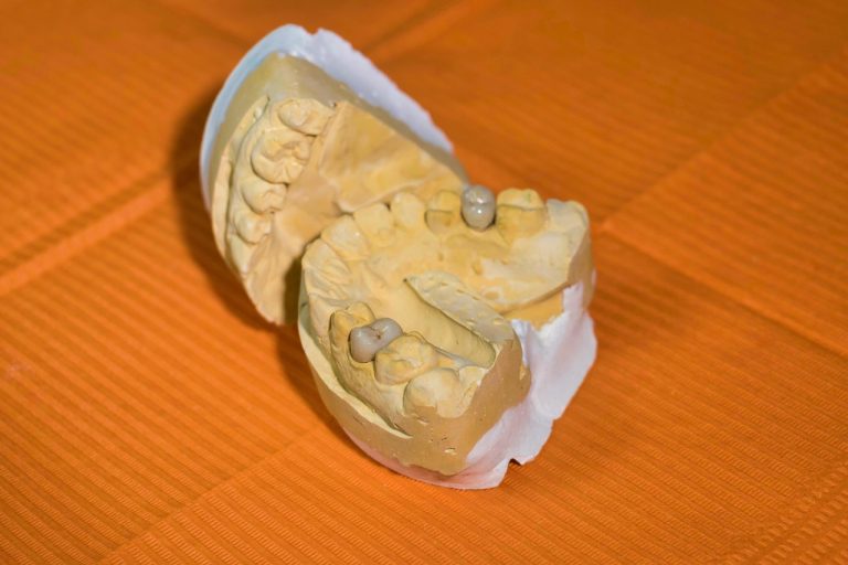 Dental lab model showing a mouth cast with crown restorations on prepared teeth