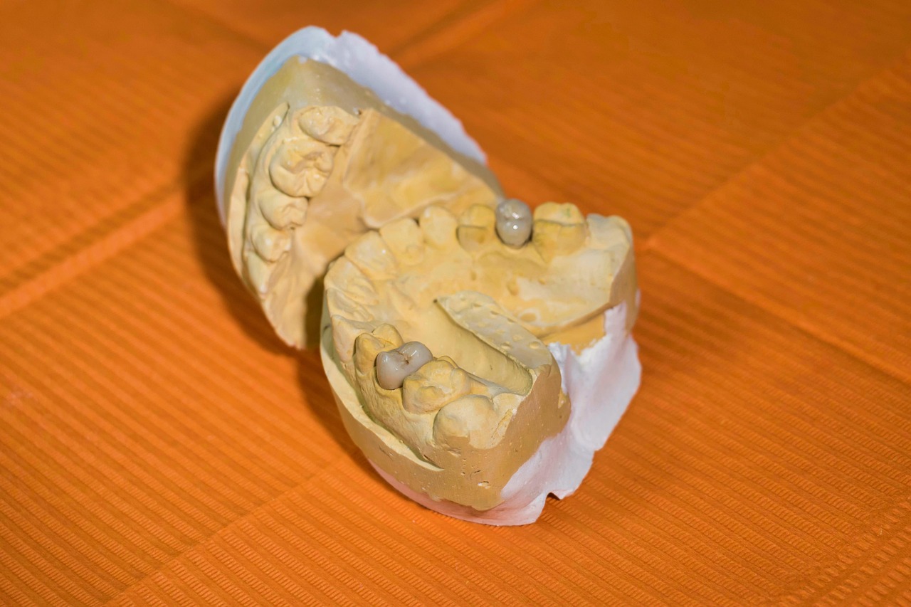 Dental lab model showing a mouth cast with crown restorations on prepared teeth