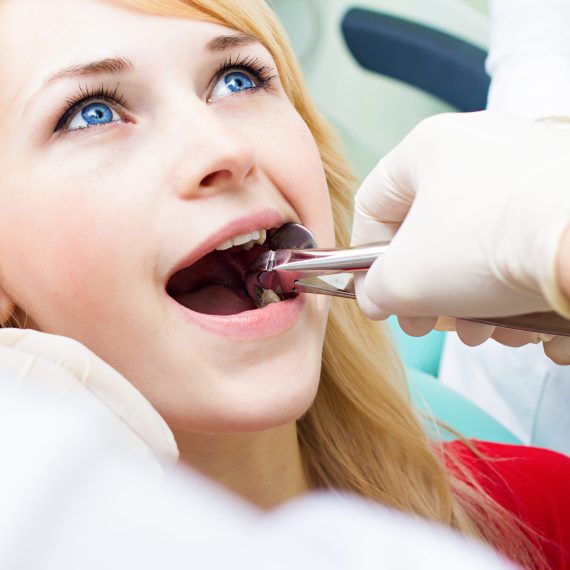 Wisdom Tooth Extraction